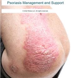 Psoriasis Management and Support