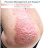 Psoriasis Management and Support